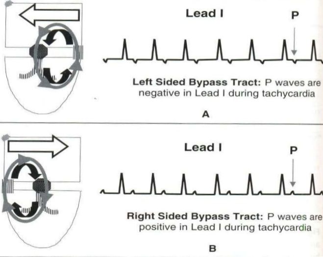 avrt l + r approach-to-a-case-of-narrow-complex-tachycardia-30-728